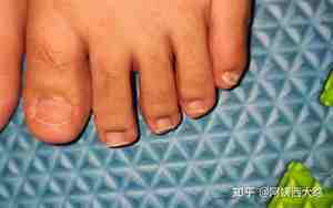 面相脚趾甲特别大怎么回事