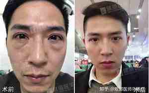 男人眼袋消除