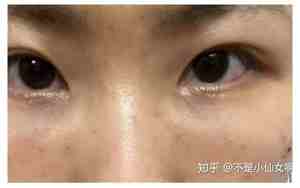 割眼袋会破坏面相吗